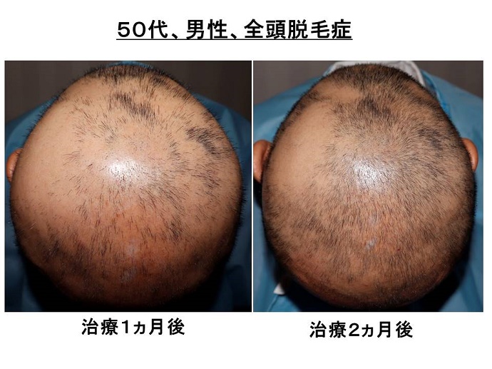 円形脱毛症　病院